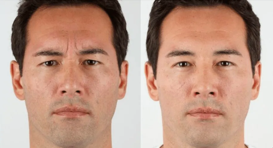 Avant après injection de Botox sur les rides du front, patiente du Dr Cayatte