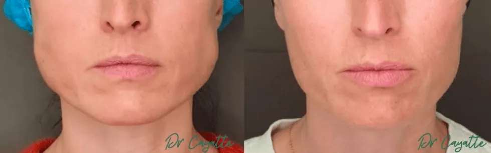 Avant après Botox des masséters pour traiter le bruxisme
