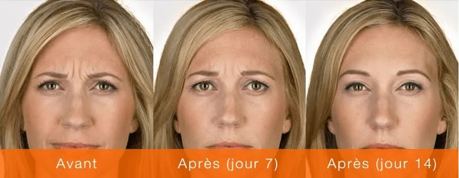 Avant après Botox sur le visage, résultat naturel à Montpellier