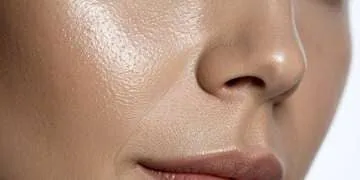 Acide hyaluronique Nez, rhinoplastie médicale à Montpellier